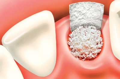 bone-graft-oral-surgery
