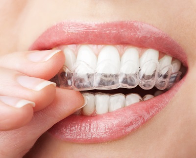 Invisalign Treatment at Linden Dental Associates